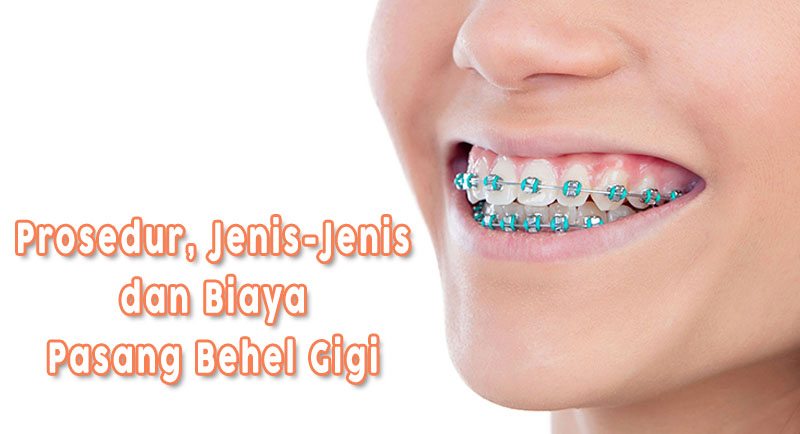 Ingin Pasang Behel? Pahami Dulu Prosedur, Jenis-Jenis dan Biayanya!